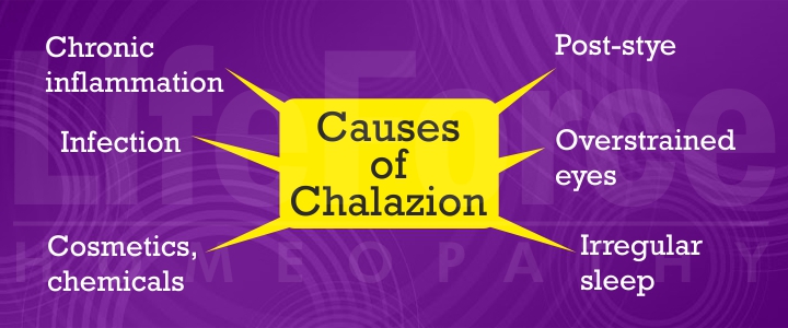 Causes of Chalazion